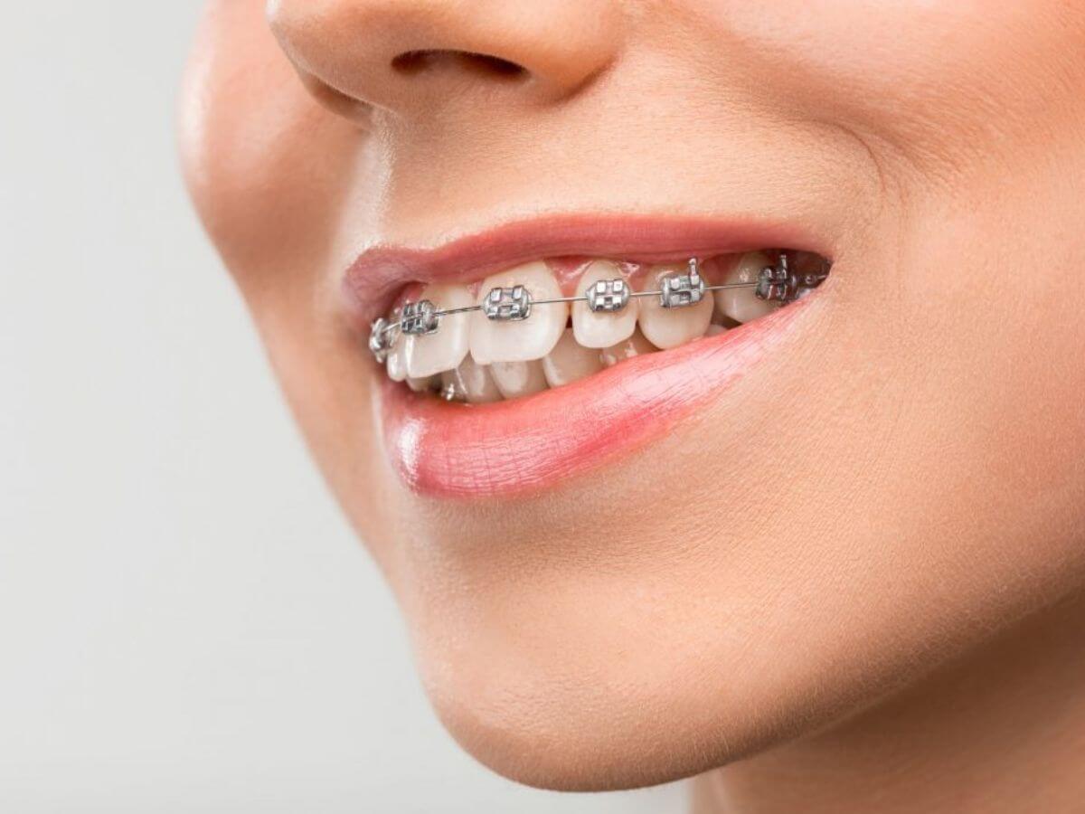 Braces Treatment In Delhi