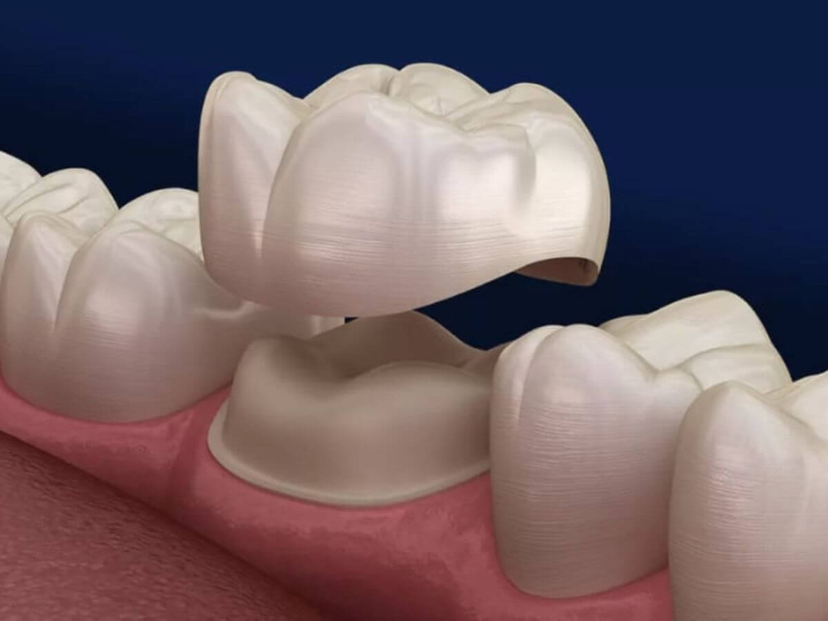 Ceramic Crowns In Delhi