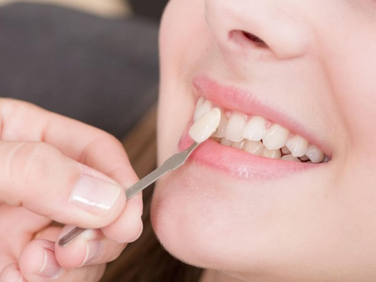 Ceramic Veneers In Delhi