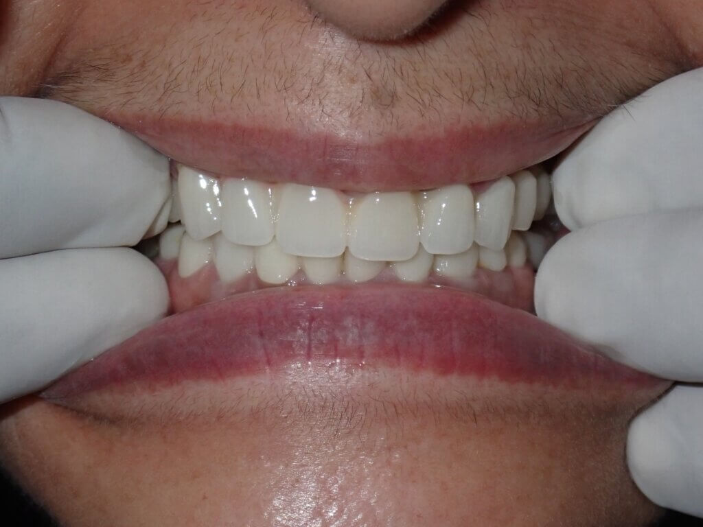 Sushma Sethi India Post Treatment1 20240907