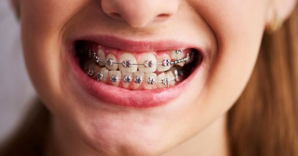 What Types Of Dental Issues Can Braces Correct