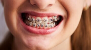 What Types Of Dental Issues Can Braces Correct