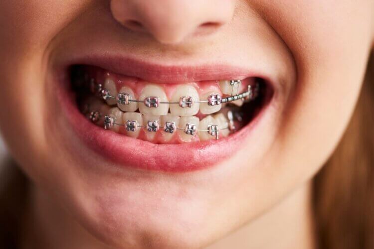 What Types Of Dental Issues Can Braces Correct
