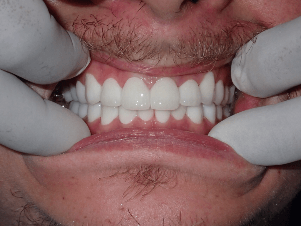After Of Full Mouth Rehabilitation