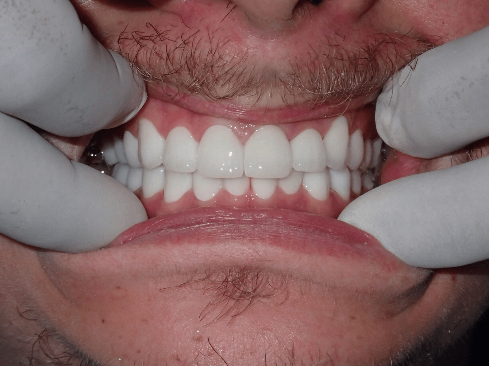 After Of Full Mouth Rehabilitation