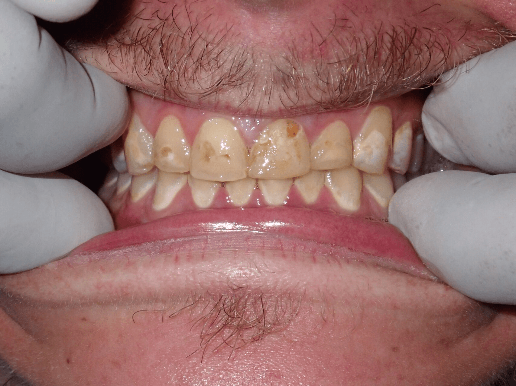 Before Of Full Mouth Rehabilitation
