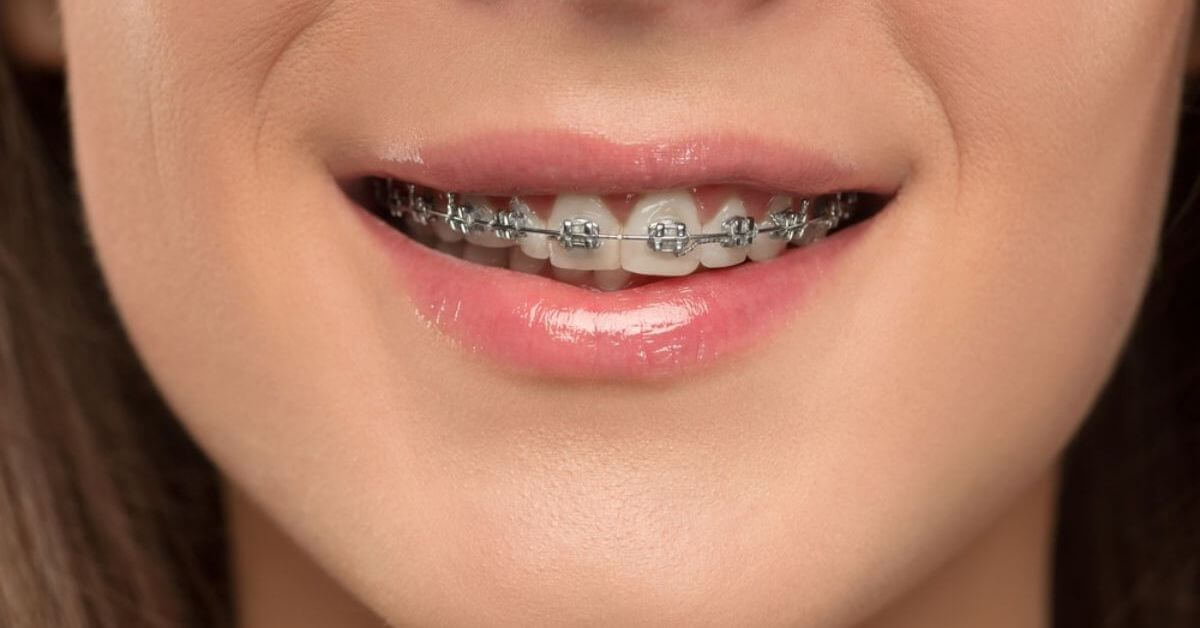 Braces 