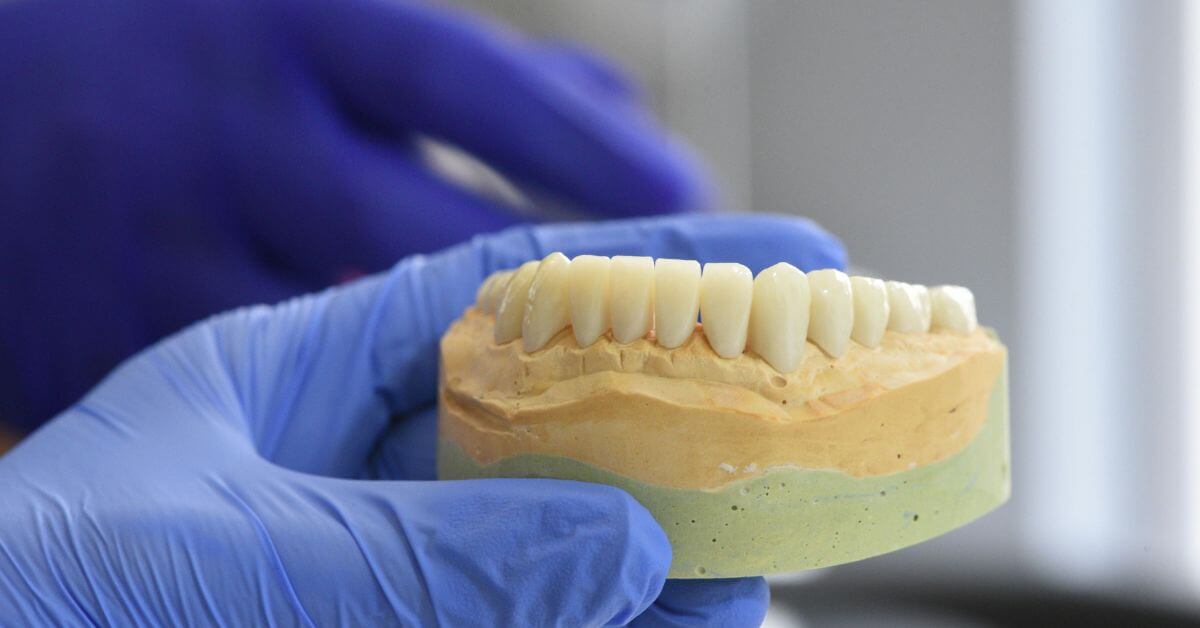 Dental Crowns In Delhi