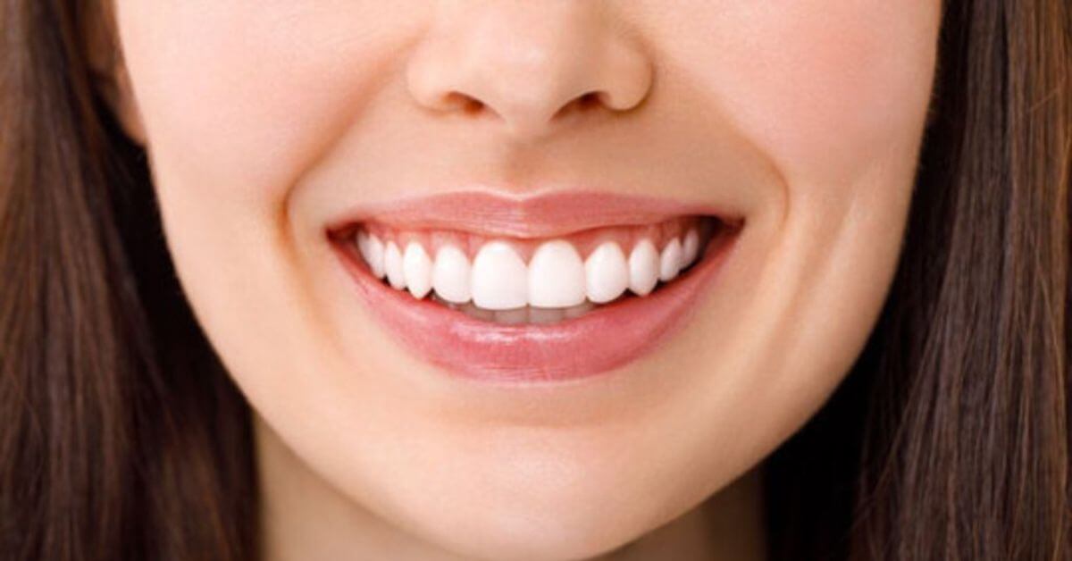Invisalign