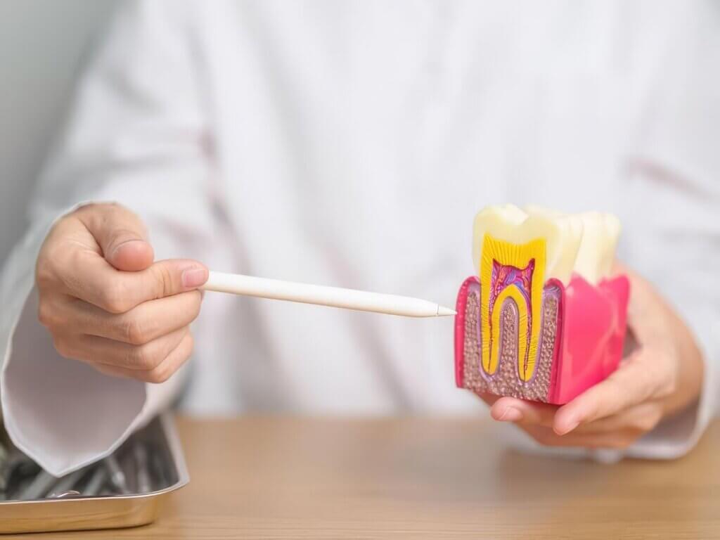 Root Canal