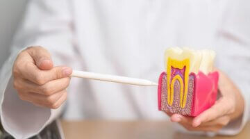 Root Canal