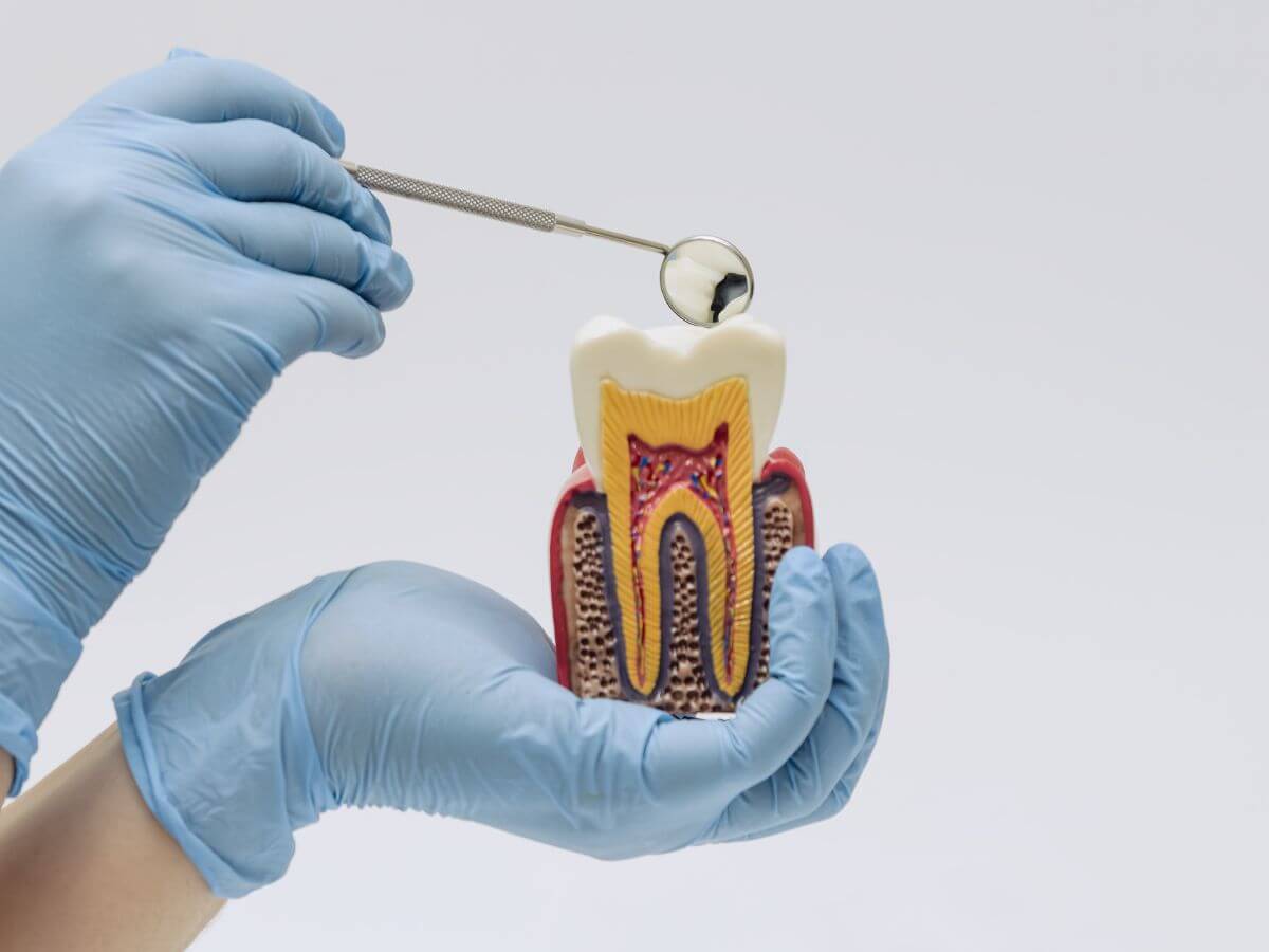 Root Canal