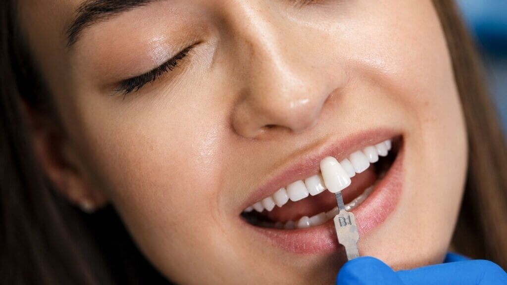 What Makes An Emax Veneer Look Like A Real Tooth?
