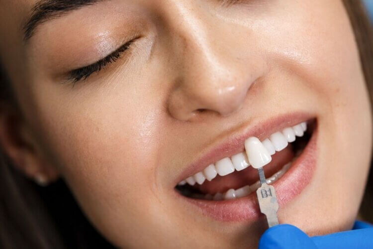What Makes An Emax Veneer Look Like A Real Tooth?