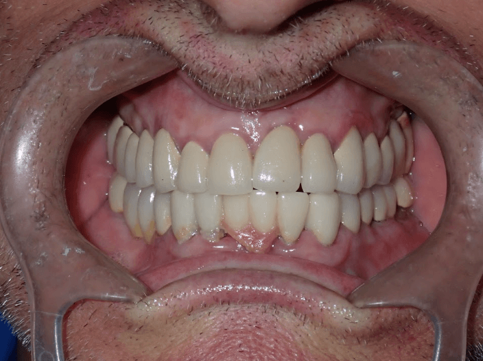 Before Of Full Arch Implant Rehabilitation
