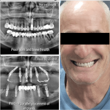 Dentist Insight Full Arch Implant Rehabilitation